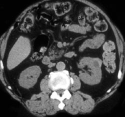 Renal Cell Carcinoma - CTisus CT Scan