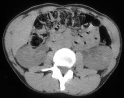 Renal Laceration - CTisus CT Scan