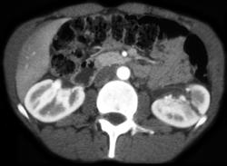 Renal Laceration - CTisus CT Scan