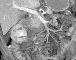 Multiple Tumors on the Right Kidney - CTisus CT Scan