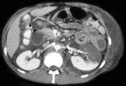 Infarcted Right Kidney - CTisus CT Scan