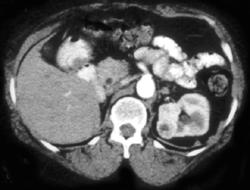 1 Cm Renal Cell Carcinoma - CTisus CT Scan