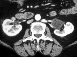 Retroaortic Left Renal Vein - CTisus CT Scan