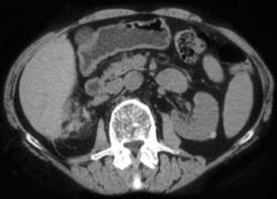 High Density Cyst Left Kidney - CTisus CT Scan