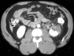 Renal Infarct - CTisus CT Scan