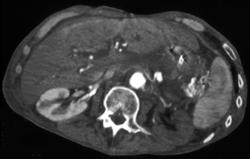 Lack of Flow to the Left Kidney - CTisus CT Scan