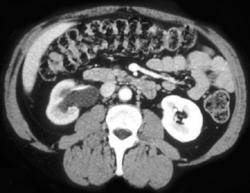 Hydronephrosis Due to Retroperitoneal Fibrosis - CTisus CT Scan