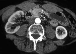 Differential Renal Function With Decreased Enhancement of Right Kidney - CTisus CT Scan