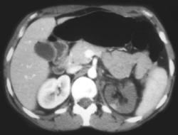 Infarcted Left Kidney (global) - CTisus CT Scan