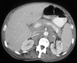 Lymphoma Involves Left Kidney - CTisus CT Scan