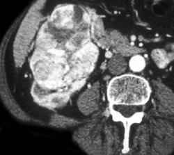 Renal Cell Carcinoma With Tumor Extension Into IVC - CTisus CT Scan