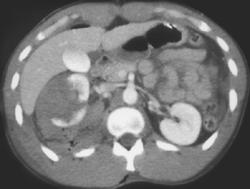 Renal Laceration - CTisus CT Scan