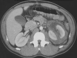 Renal Laceration With Tear of Pelvis Obvious on Late Phase Images - CTisus CT Scan