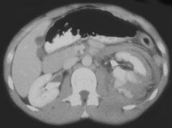 Renal Laceration With Active Bleeding - CTisus CT Scan