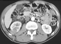 Clot in Right Renal Pelvis Following A Renal Biopsy - CTisus CT Scan