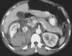 Renal Laceration With Perirenal Bleed - CTisus CT Scan