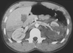 Multiple Lacerations in Left Kidney - CTisus CT Scan