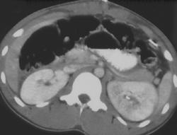 Pyelonephritis Left Kidney - CTisus CT Scan