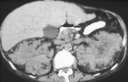 Extramedullary Hematopoiesis Involves the Kidneys - CTisus CT Scan