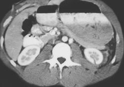 Renal Laceration - CTisus CT Scan