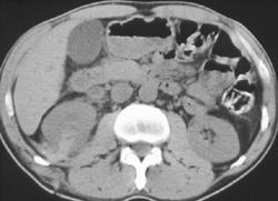 Renal Laceration - CTisus CT Scan