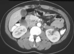 Renal Laceration - CTisus CT Scan