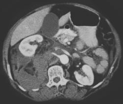 Right Perirenal Hematoma Post Procedure - CTisus CT Scan