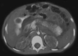 Shock Bowel With IVC Extravasation and Slow Flow to Kidney - CTisus CT Scan