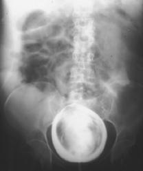 Intraperitoneal Bladder Laceration - CTisus CT Scan