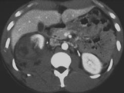 Contrast Extravasation Due to Renal Laceration - CTisus CT Scan