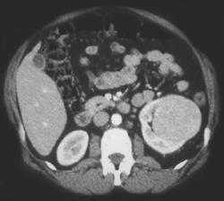 Oncocytoma - CTisus CT Scan