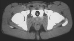 Bladder Tear With Contrast Extravasation - CTisus CT Scan