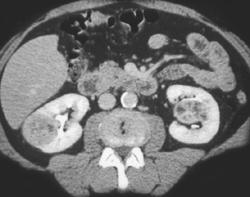 Bilateral Renal Cell Carcinoma - CTisus CT Scan