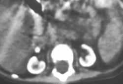 Oxalosis - CTisus CT Scan