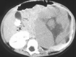 Wilms Tumor - CTisus CT Scan