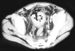 Perforated Bladder Due to Hemorrhage Cystitis - CTisus CT Scan