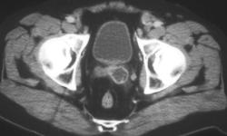 Seminal Vesicle Abscess - CTisus CT Scan