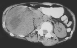 Wilms Tumor in Radiated Tumor Bed - CTisus CT Scan