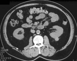 High Density Renal Cyst - CTisus CT Scan