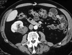 Renal Cell Carcinoma - CTisus CT Scan