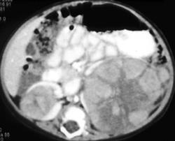 Bilateral Wilms Tumors - CTisus CT Scan