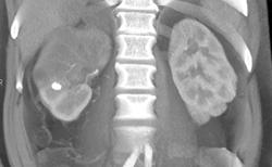 Transitional Cell Carcinoma - CTisus CT Scan