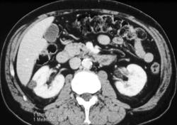 Metastatic Renal Cell Cancer - CTisus CT Scan