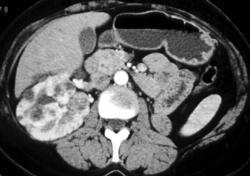 Multiple Renal Cell Carcinomas in A Patient With Von Hippel-Lindau syndrome (VHL) - CTisus CT Scan