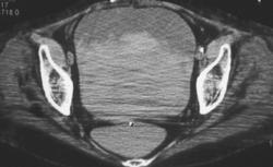 Glycosuria - CTisus CT Scan