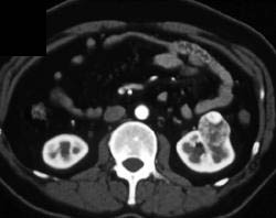 Renal Cell Carcinoma - CTisus CT Scan