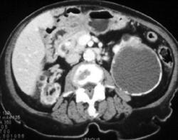 Old Renal Hematoma (cystic Uremic Disease) - CTisus CT Scan