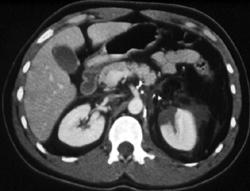 Infarct Left Kidney - CTisus CT Scan