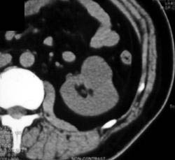 Renal Cell Carcinoma - CTisus CT Scan