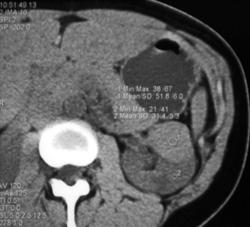 High Density Renal Cyst - CTisus CT Scan